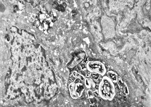 F,17y. | congenital liver fibrosis … myelinoid inclusions